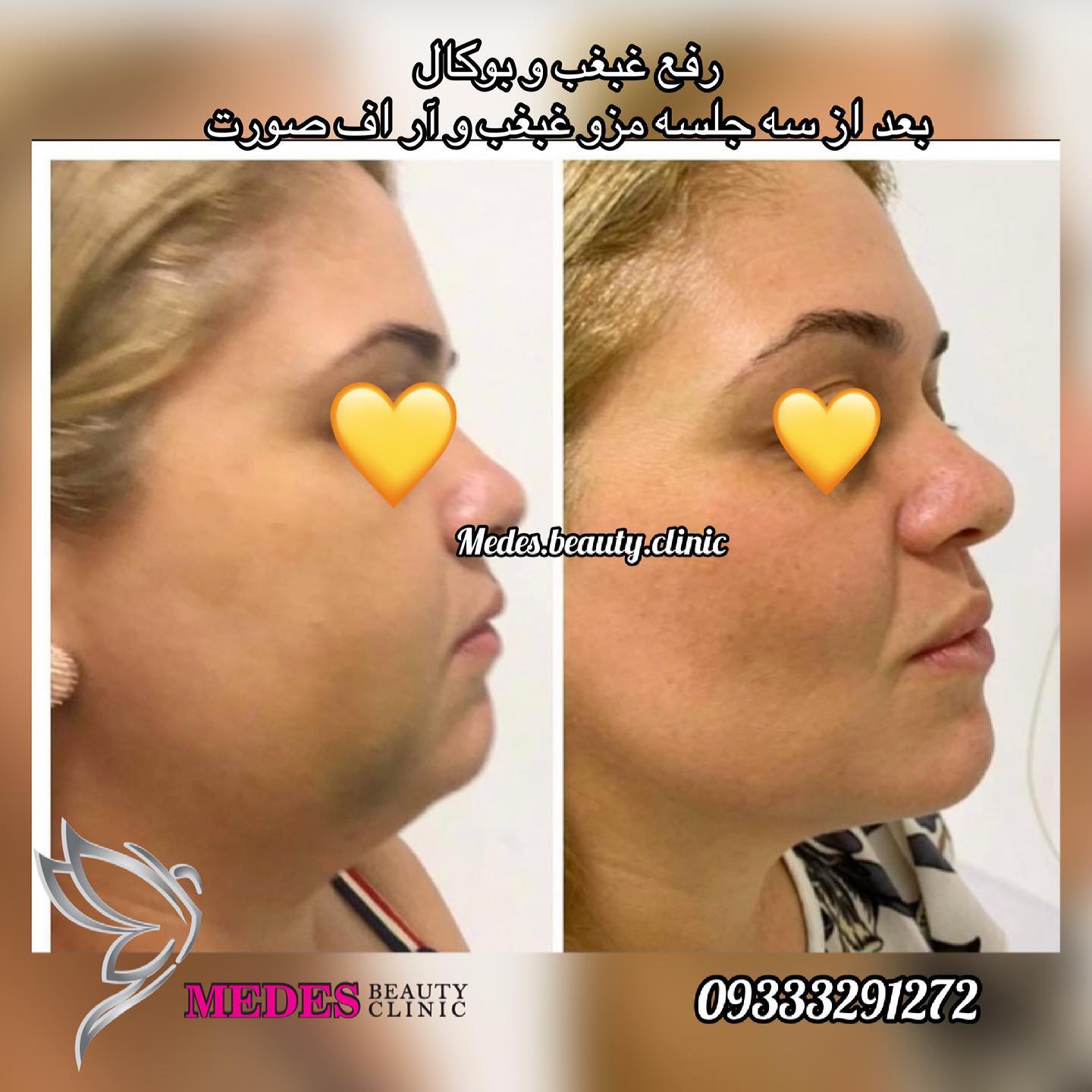 گالری مزوتراپی